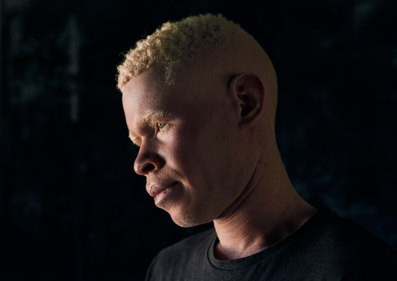 Charles, 16, Democratic Republic of the Congo. Charles, 16, lived with his mother and father in the Democratic Republic of the Congo. His family was forced to leave because Charles was persecuted for being a person with albinism. 