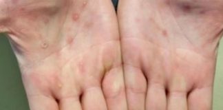 CDC Las lesiones de la viruela del mono suelen aparecer en las palmas de las manos