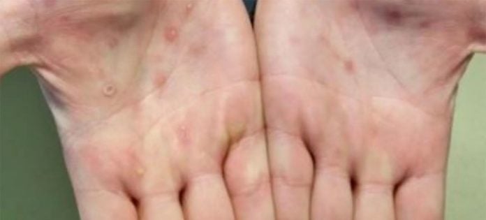 CDC Las lesiones de la viruela del mono suelen aparecer en las palmas de las manos