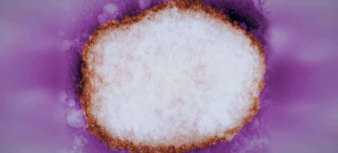 Imagem ampliada mostra uma partícula do vírus da varíola do tipo amora, que foi encontrada no fluido de uma bolha humana.