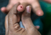 Ett finger i närbild med en droppe blod